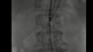 Установка BeGraft