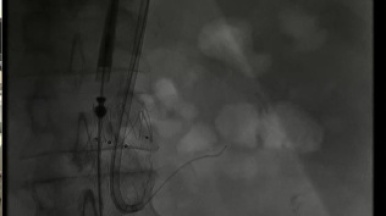 Установка BeGraft